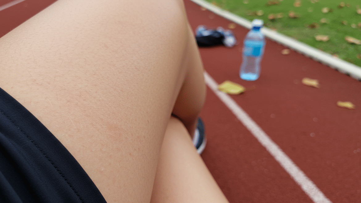 Obtarcie uda po bieganiu – przyczyny, zapobieganie i leczenie